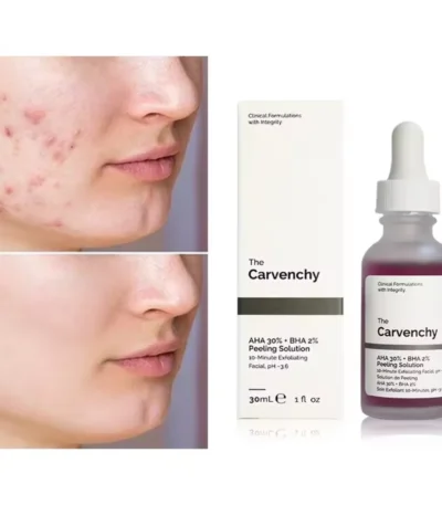 Chemical Peel for Acne
