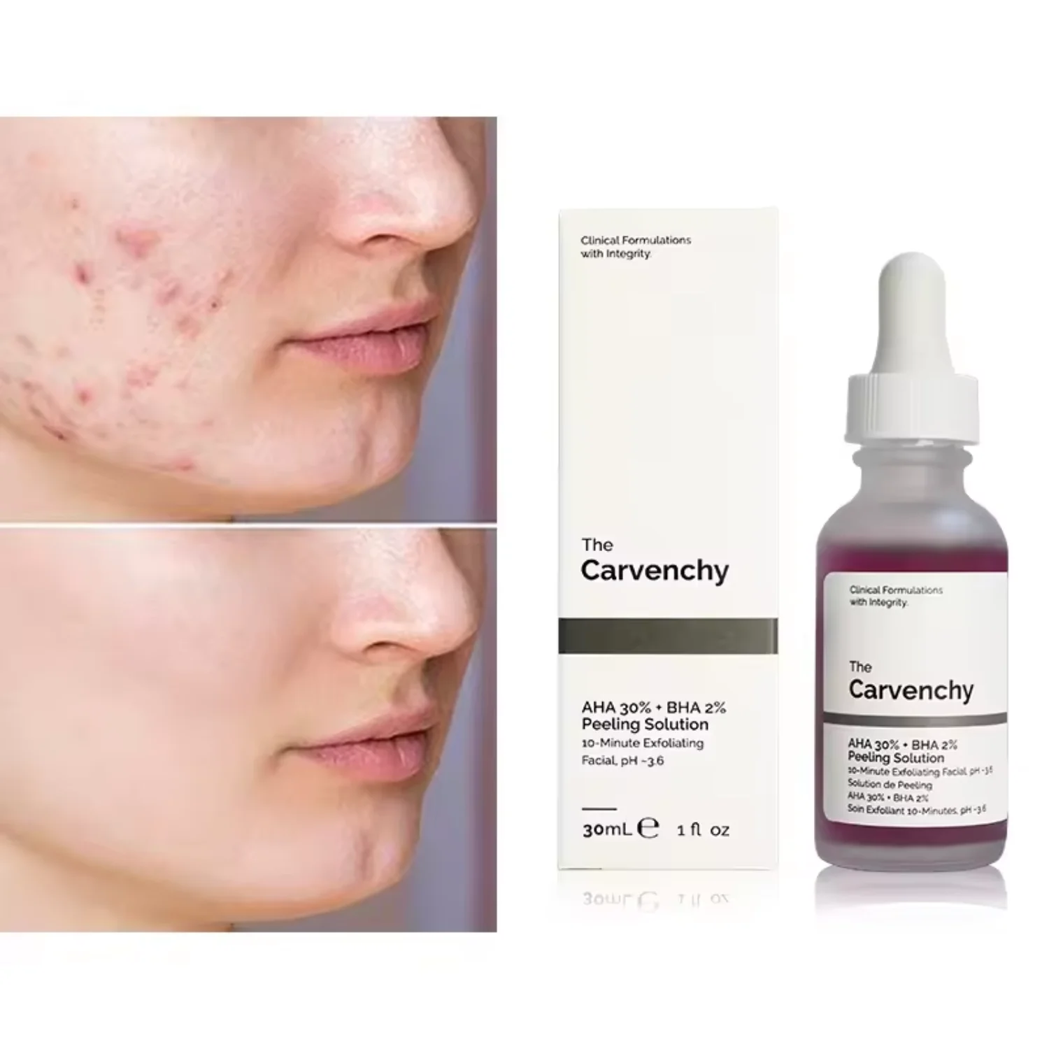 Chemical Peel for Acne
