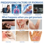 Herbal Extract Psoriasis Ointment